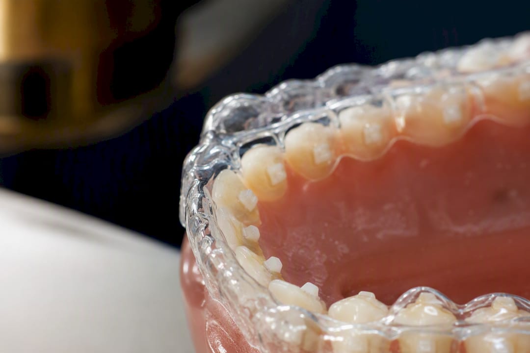 Teeth with dental attachments under clear aligner