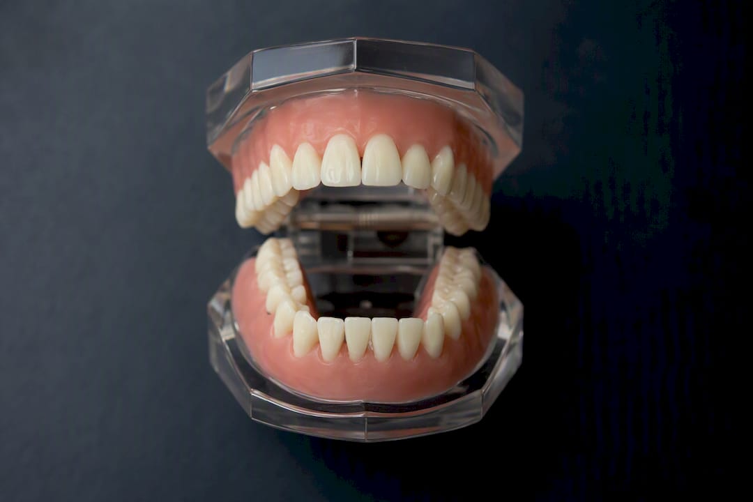 Dental model showing open bite condition