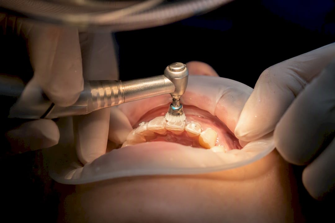 Dental polishing brush on tooth enamel surface