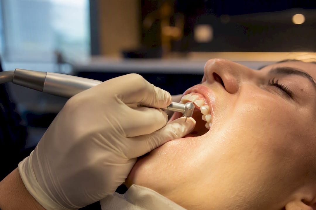 Carbide then Polish: Remove Invisalign Attachments Without Enamel Damage