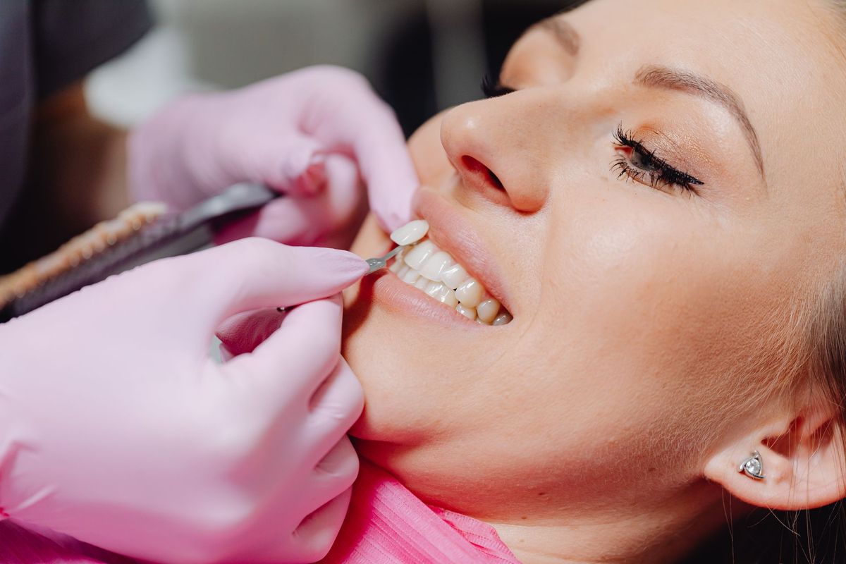 3D Hybrid Veneers