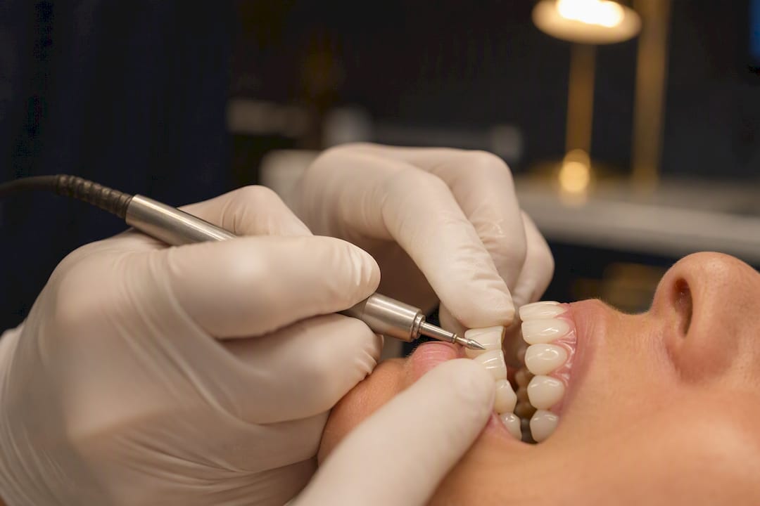 Can veneers be removed, and what happens to your teeth after?